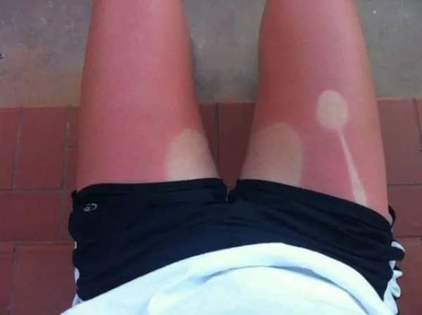 Sunburned legs with pale outlines of a tennis racket and balls left behind