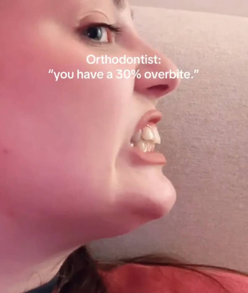 Woman showing her dramatic thirty percent overbite as an example of wabi sabi features.