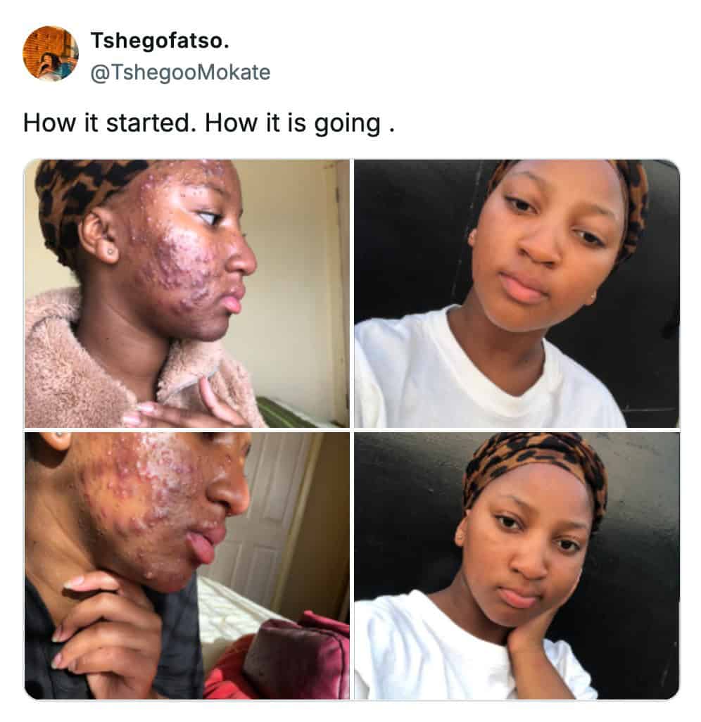 A how it started vs how its going meme showing a woman's skincare journey clearing severe acne.
