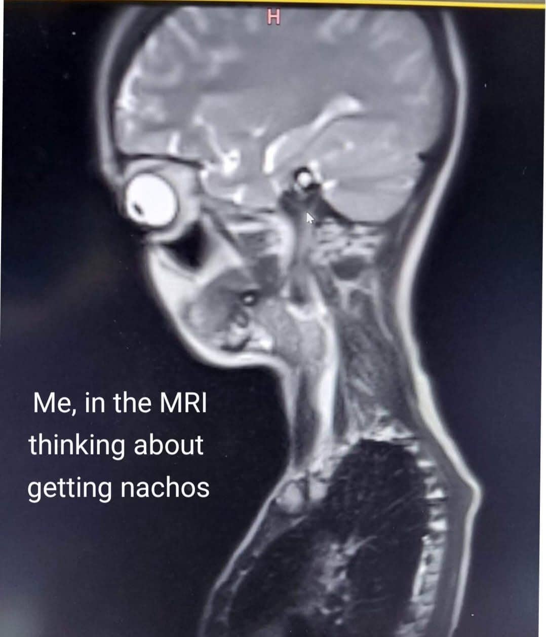 Comedic medical scan meme displaying an MRI profile with text about thinking of getting nachos.
