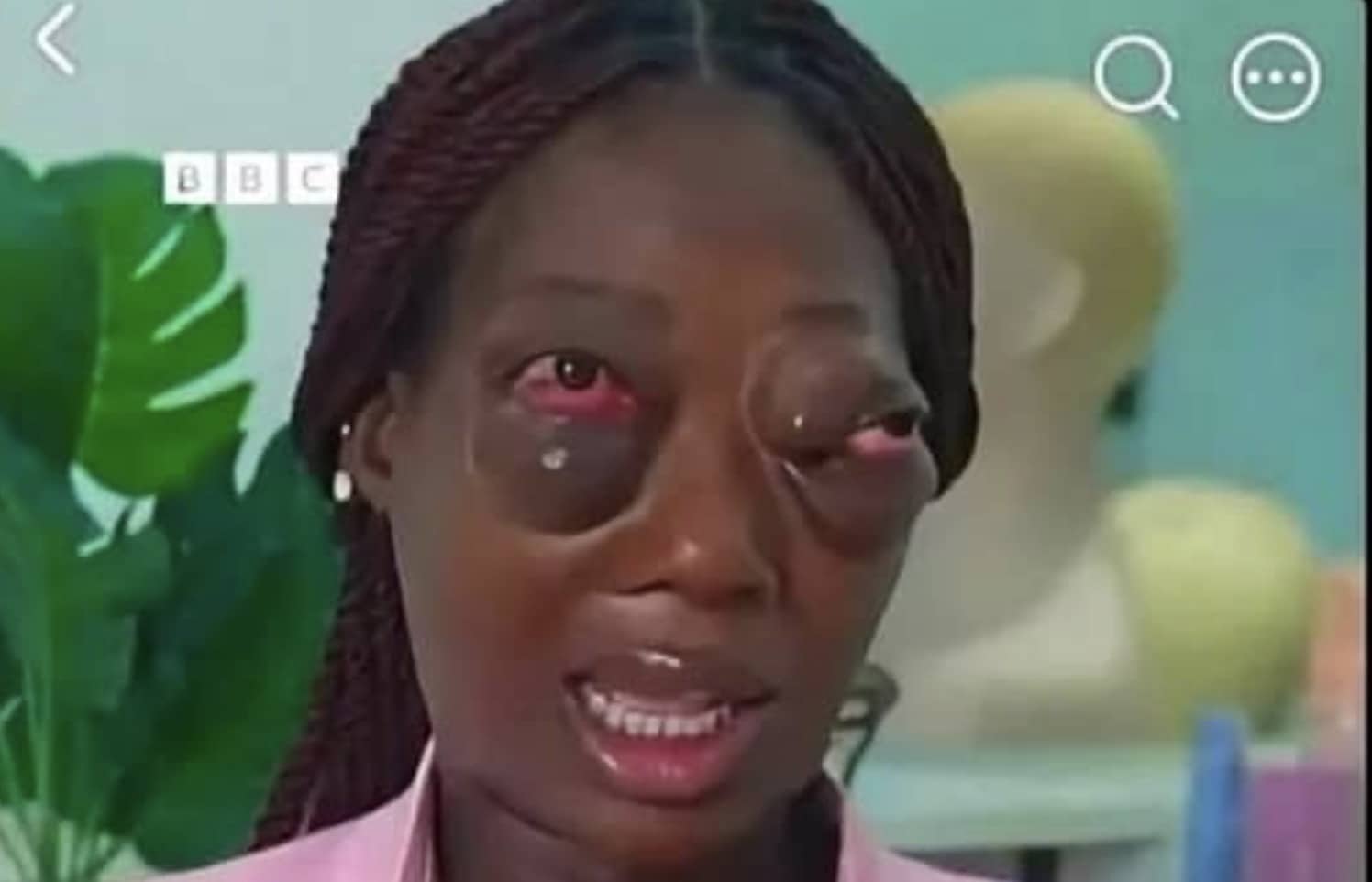 Woman with severely swollen eyelids speaking during a BBC broadcast interview funny meme.