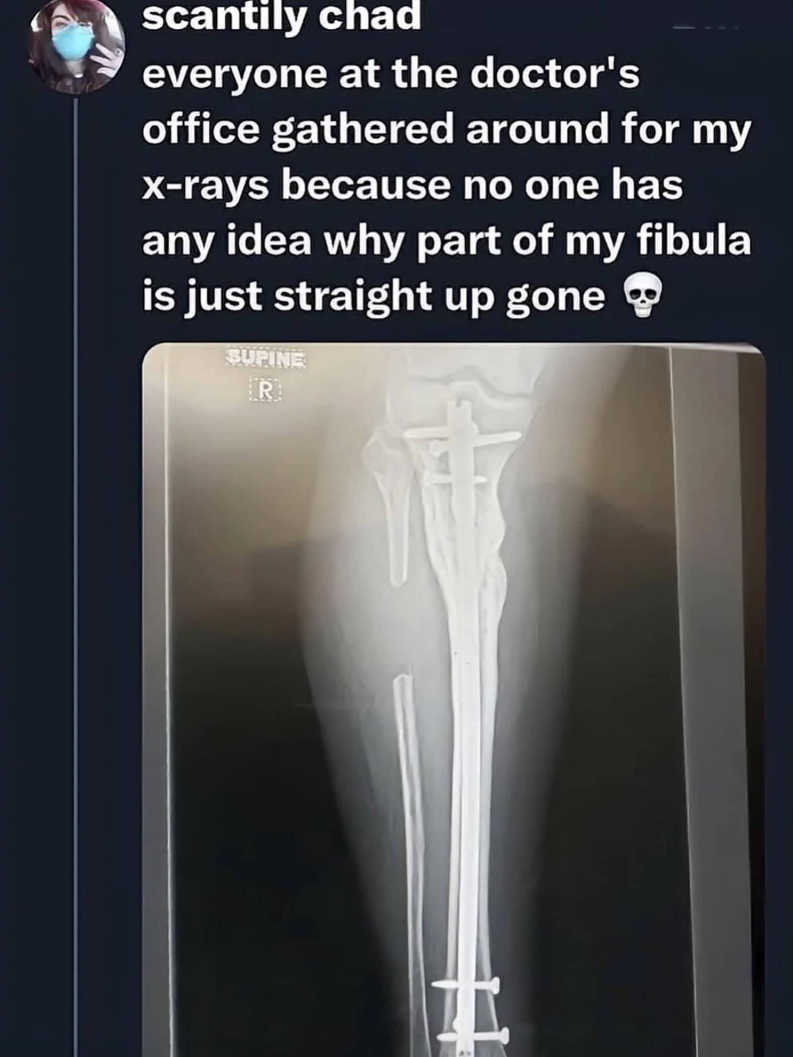 Leg x-ray scan displaying a missing portion of the fibula bone, funny memes.