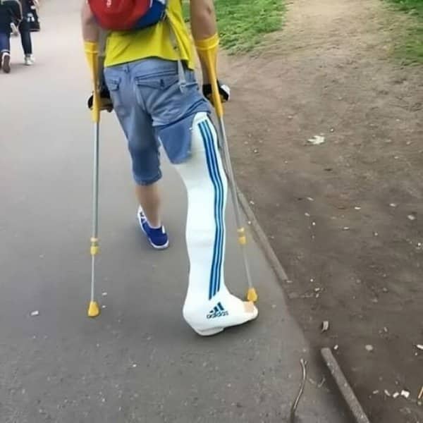 Person on crutches wearing a leg cast styled with iconic blue Adidas stripes and logo.