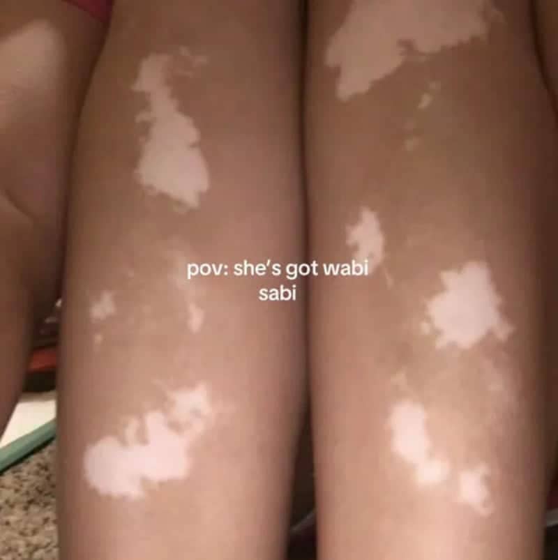 Person showing skin with vitiligo patches proudly participating in the wabi sabi features trend.